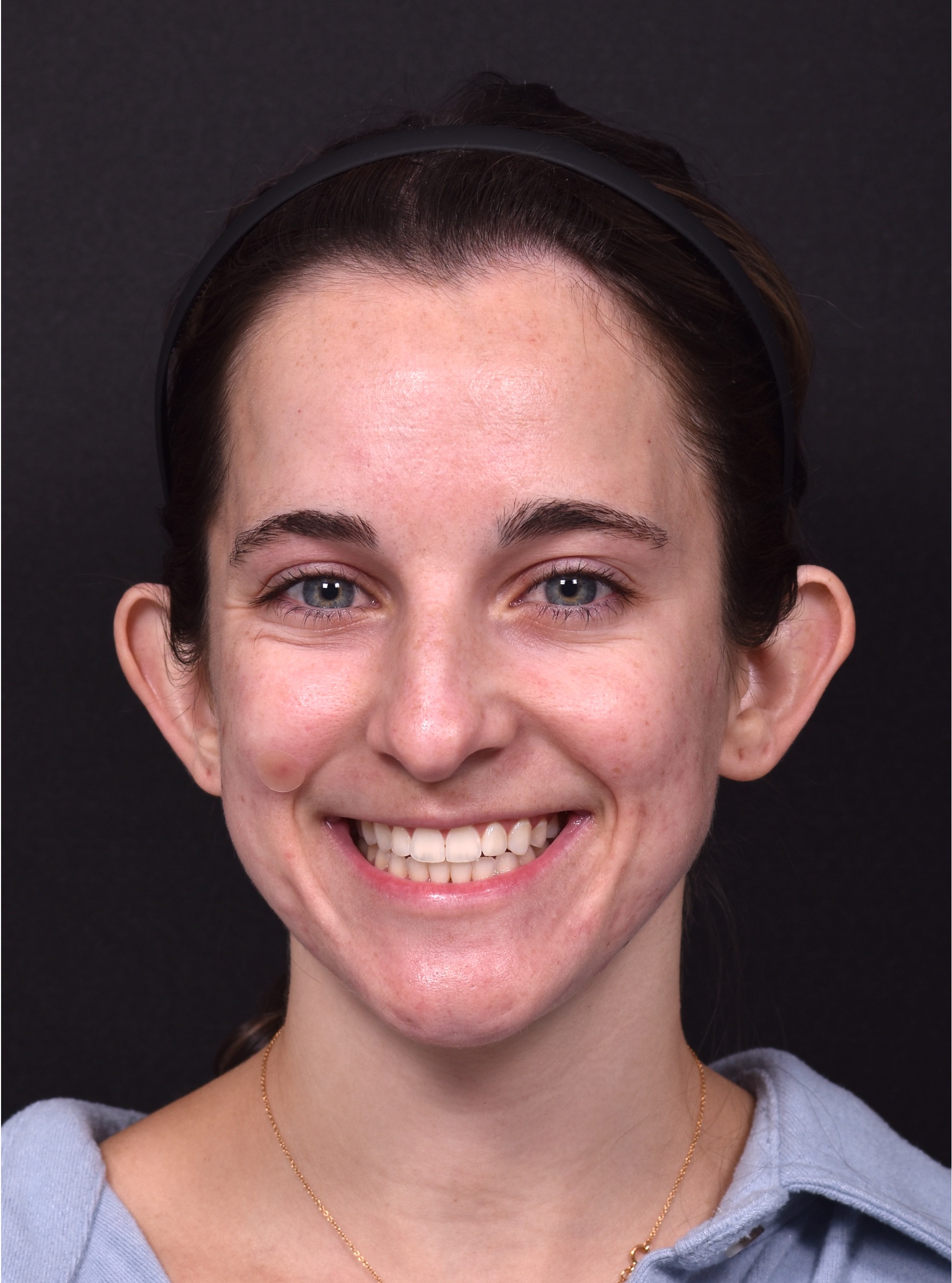 Atlanta otoplasty best before after expert top plastic surgeon ear lopear