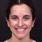 Atlanta otoplasty best before after expert top plastic surgeon ear lopear
