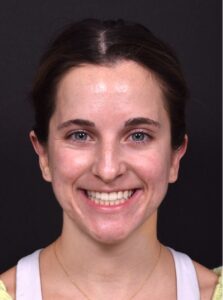 Atlanta otoplasty best before after expert top plastic surgeon ear lopear