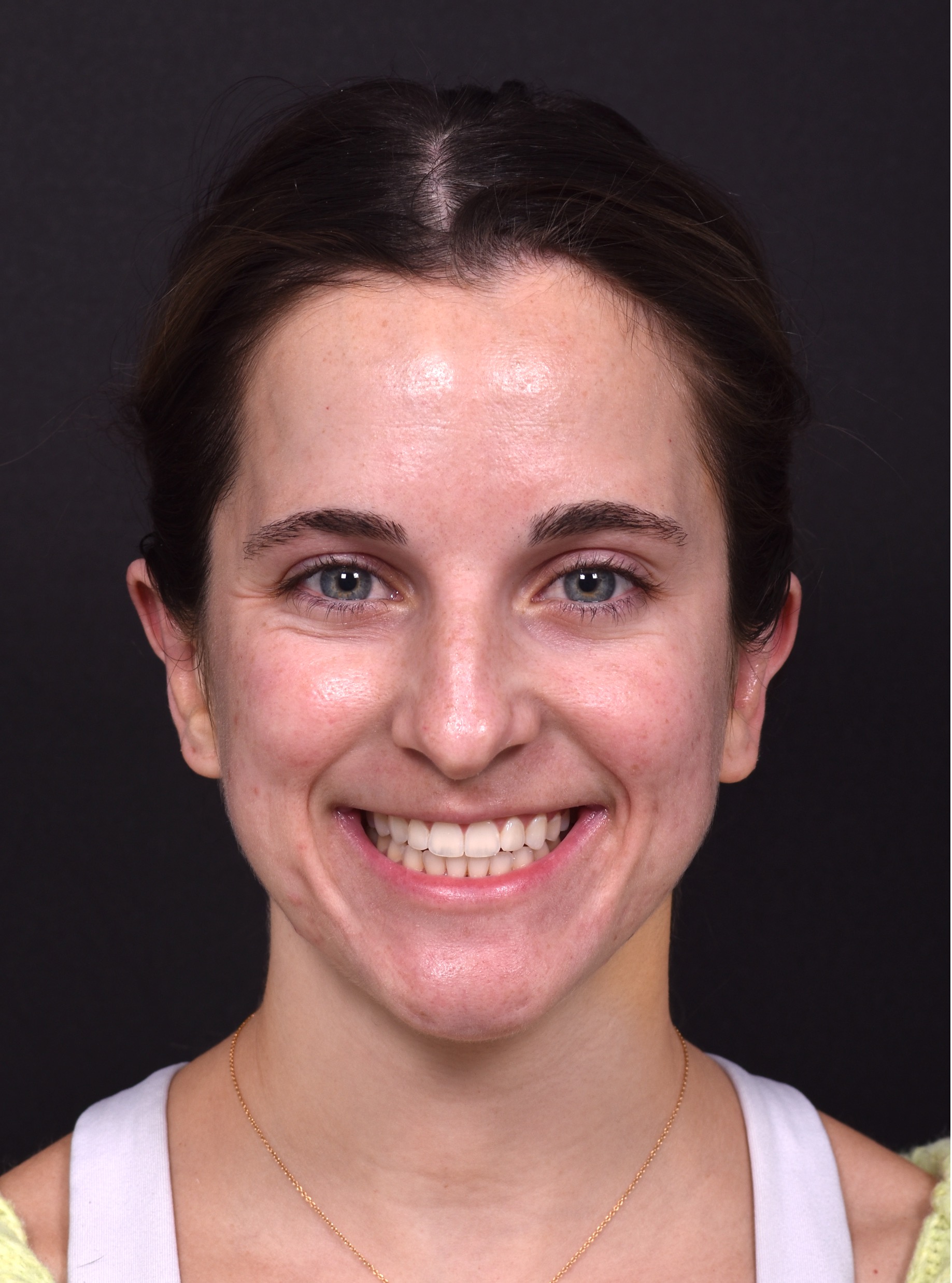 Atlanta otoplasty best before after expert top plastic surgeon ear lopear