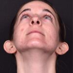Otoplasty ear pinning lop ear surgery Atlanta best expert before after