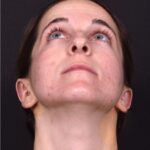 Otoplasty ear pinning lop ear surgery Atlanta best expert before after