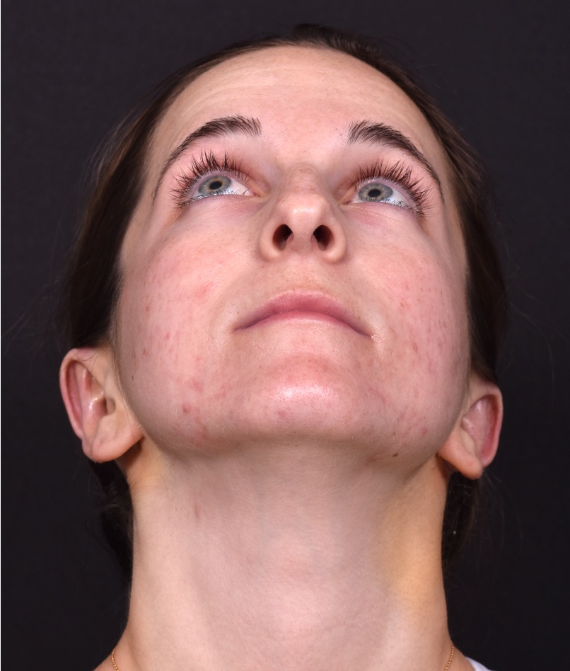 Otoplasty ear pinning lop ear surgery Atlanta best expert before after