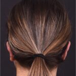 Otoplasty Atlanta ear surgery ear pinning best expert before after