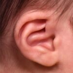 Earwell earbuddies newborn ear correction splinting molding Dr. Fishman before after expert best baby