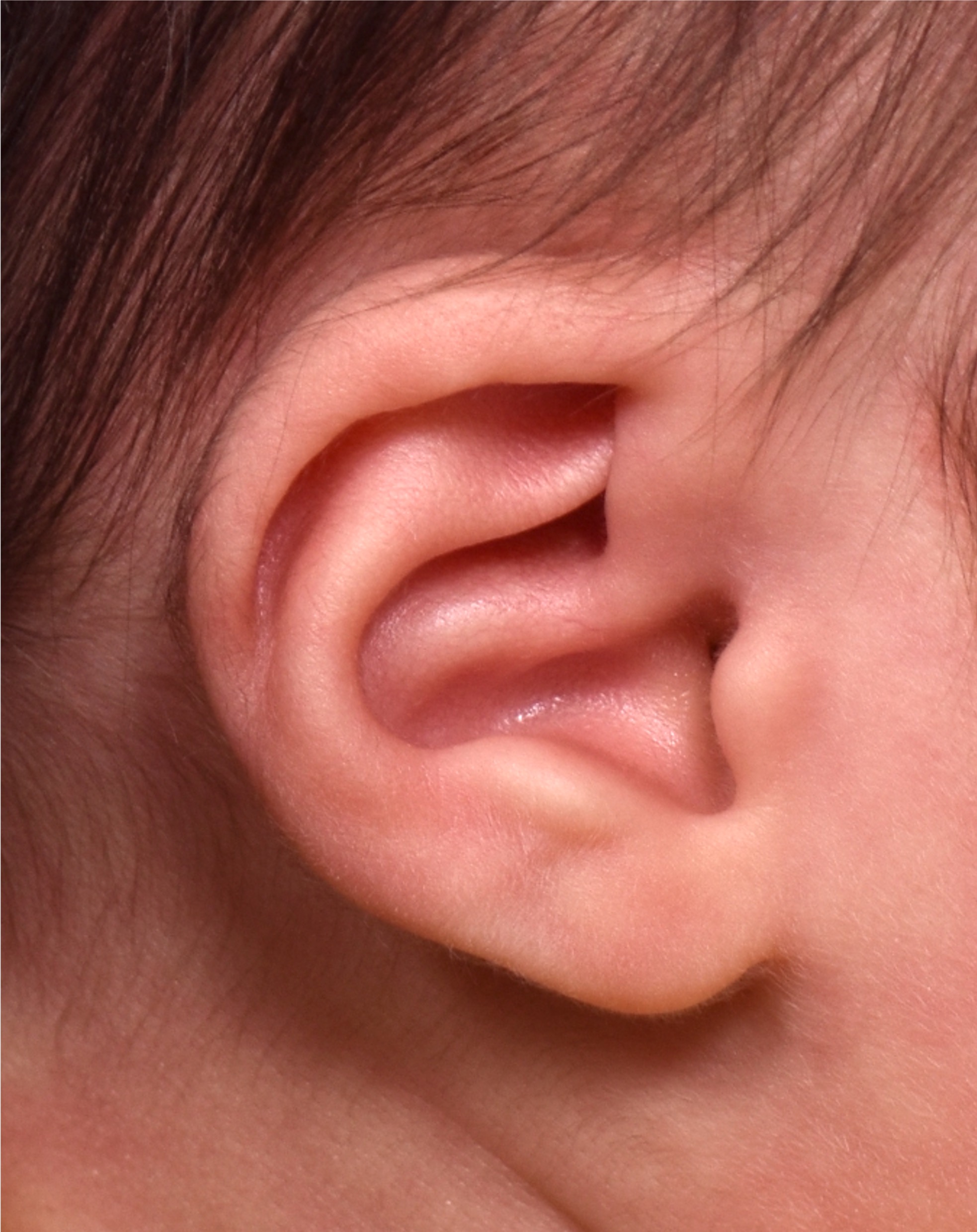 Earwell earbuddies newborn ear correction splinting molding Dr. Fishman before after expert best baby