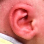 Earwell earbuddies newborn ear correction splinting molding Dr. Fishman before after expert best baby