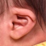 Earwell earbuddies newborn ear correction splinting molding Dr. Fishman before after expert best baby