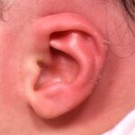 Earwell earbuddies newborn ear correction splinting molding Dr. Fishman before after expert best baby