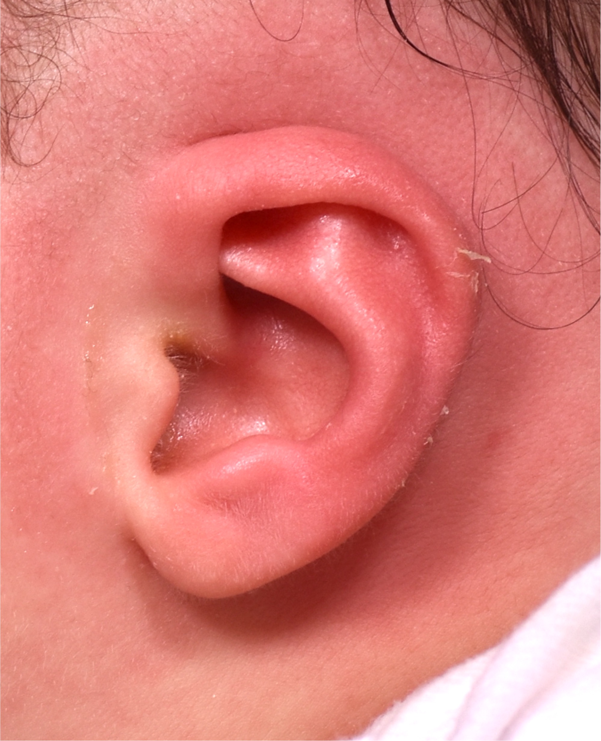 Earwell earbuddies newborn ear correction splinting molding Dr. Fishman before after expert best baby