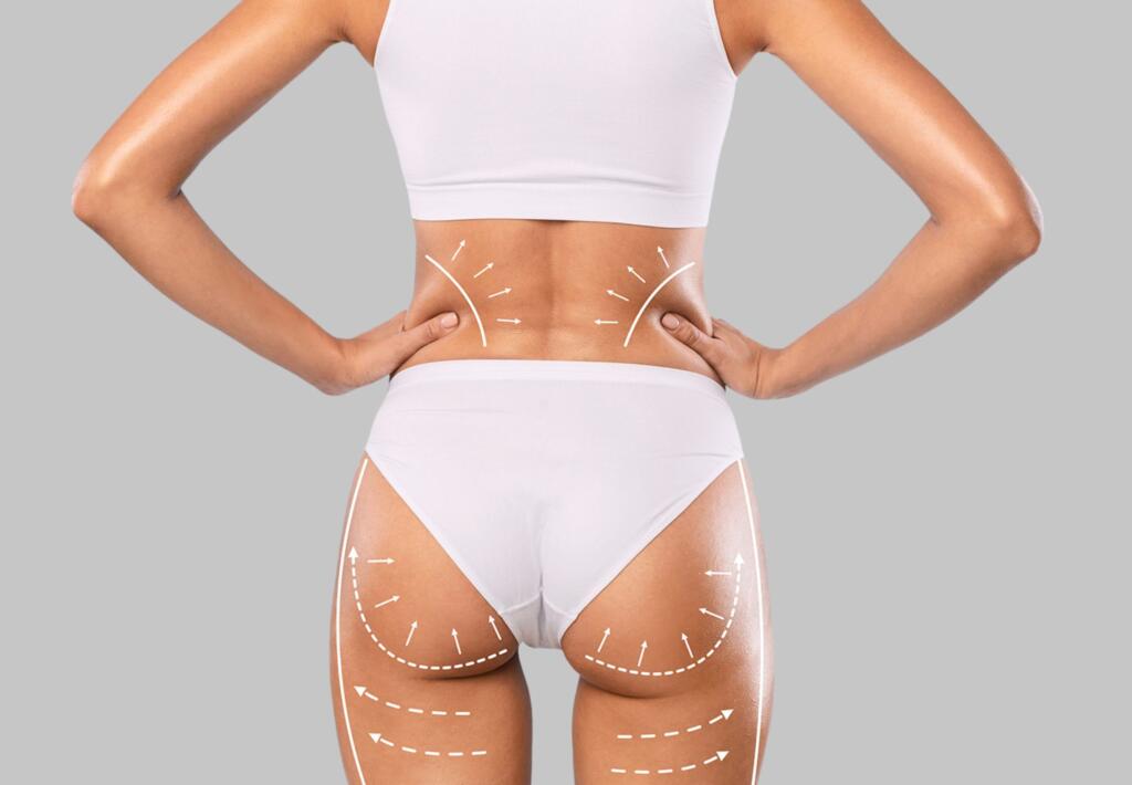 Non-Surgical BBL