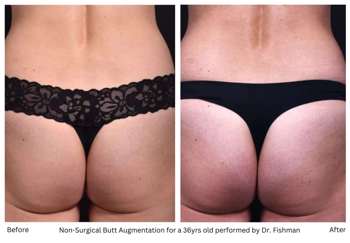 Brazilian Butt Lift (BBL): Before & After Photos Atlanta