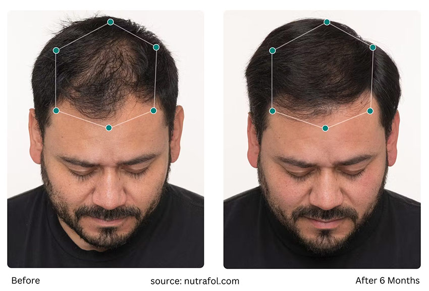 Nutrafol Before After