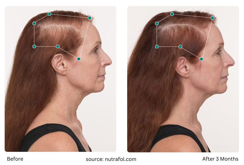 Nutrafol Before After