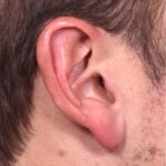 Earlobe reduction near me Atlanta long earlobes ears otoplasty surgery best expert before and after