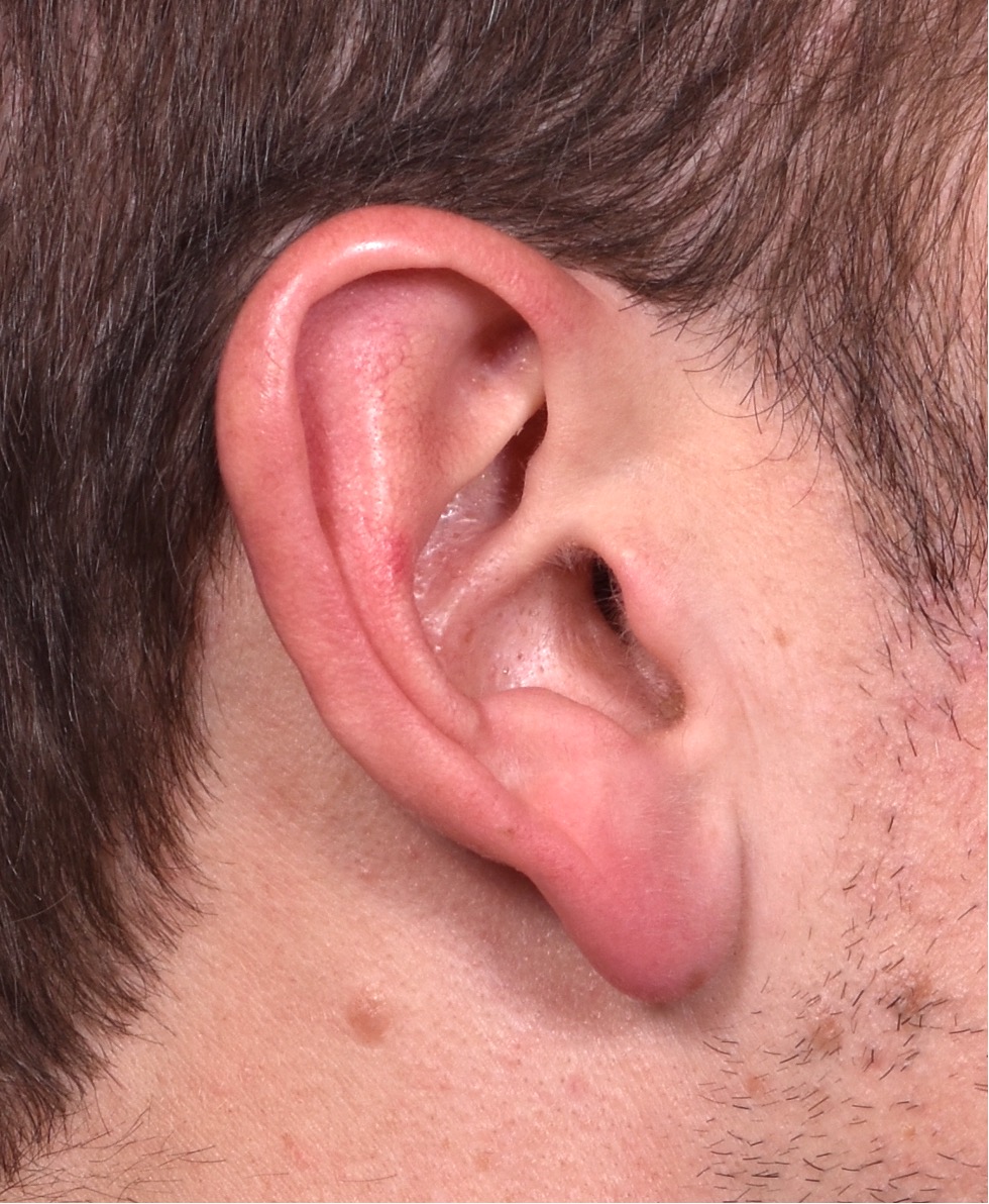 Earlobe reduction near me Atlanta long earlobes ears otoplasty surgery best expert before and after