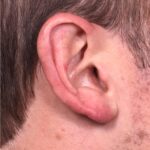 Earlobe reduction near me Atlanta long earlobes ears otoplasty surgery best expert before and after