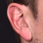 Earlobe reduction near me Atlanta long earlobes ears otoplasty surgery best expert before and after