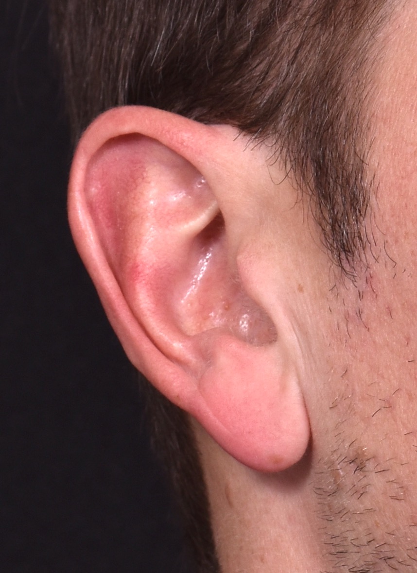 Earlobe reduction near me Atlanta long earlobes ears otoplasty surgery best expert before and after