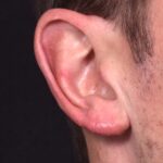 Earlobe reduction near me Atlanta long earlobes ears otoplasty surgery best expert before and after