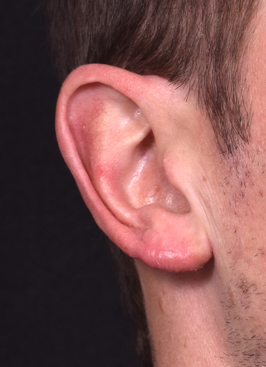 Earlobe reduction near me Atlanta long earlobes ears otoplasty surgery best expert before and after