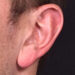Earlobe reduction near me Atlanta long earlobes ears otoplasty surgery best expert before and after