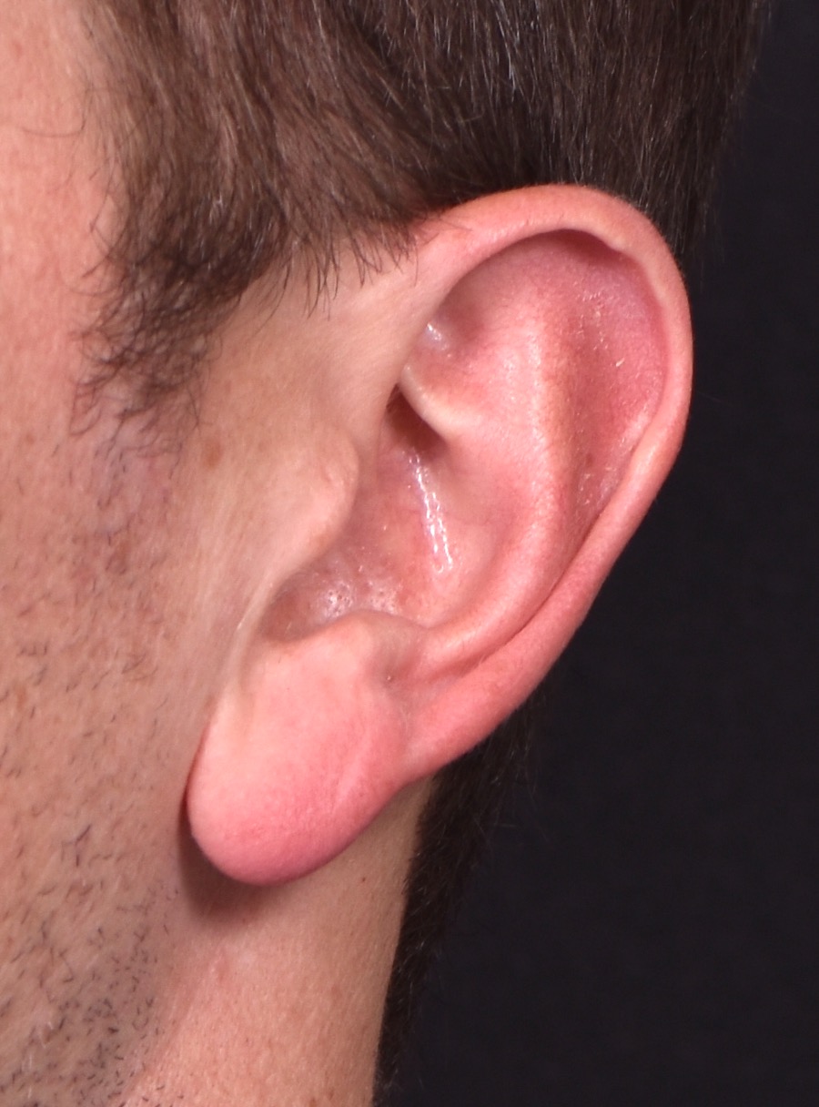 Earlobe reduction near me Atlanta long earlobes ears otoplasty surgery best expert before and after