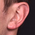 Earlobe reduction near me Atlanta long earlobes ears otoplasty surgery best expert before and after