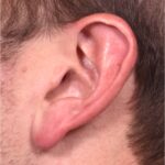 Earlobe reduction near me Atlanta long earlobes ears otoplasty surgery best expert before and after