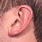 Earlobe reduction near me Atlanta long earlobes ears otoplasty surgery best expert before and after
