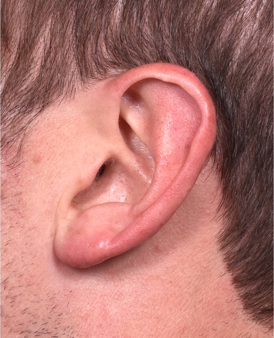 Earlobe reduction near me Atlanta long earlobes ears otoplasty surgery best expert before and after