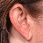 Atlanta earlobe repair before after best expert ear surgery
