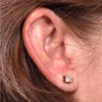 Atlanta earlobe repair before after best expert ear surgery