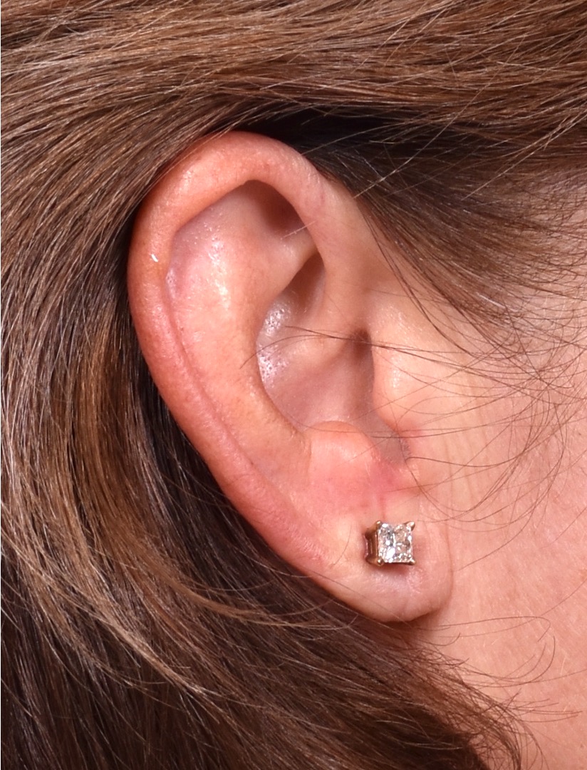 Atlanta earlobe repair before after best expert ear surgery