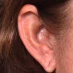 Atlanta earlobe repair reduction before after best expert ear surgery