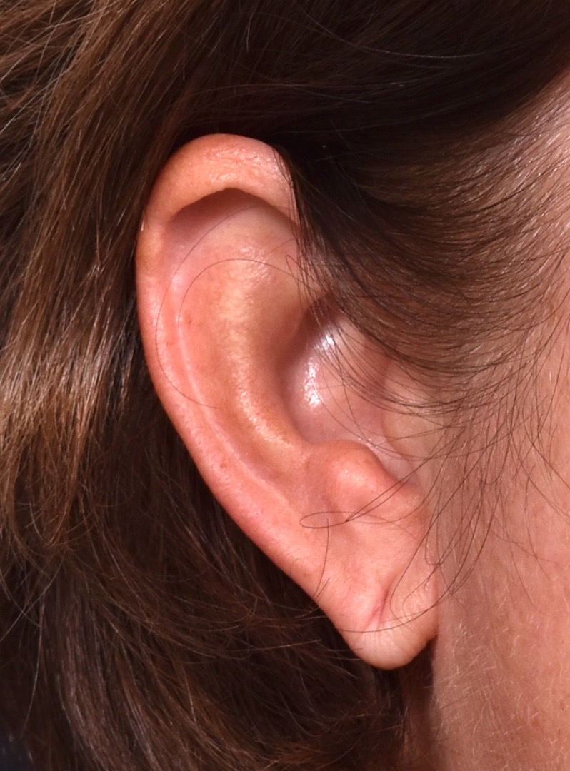 Atlanta earlobe repair reduction before after best expert ear surgery