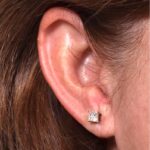 Atlanta earlobe repair reduction before after best expert ear surgery