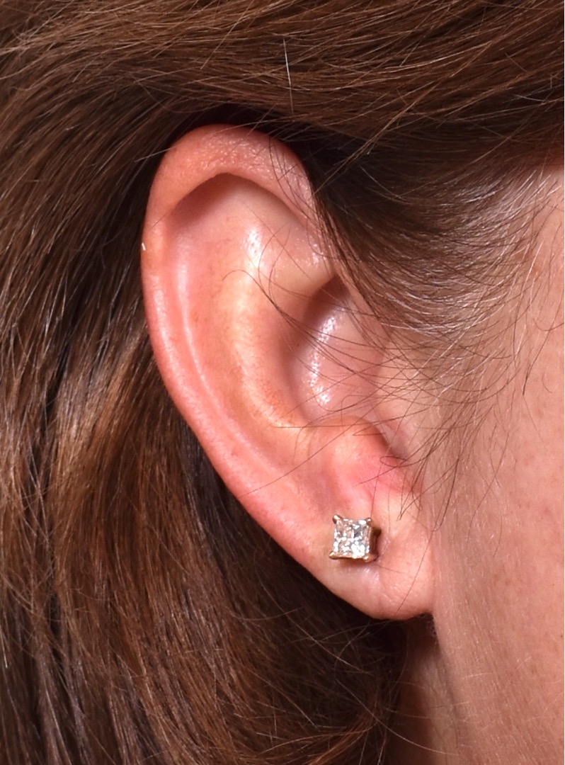 Atlanta earlobe repair reduction before after best expert ear surgery
