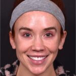 Atlanta chin implant best augmentation before after expert plastic surgery