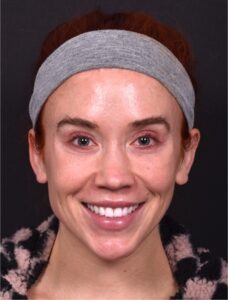 Atlanta chin implant best augmentation before after expert plastic surgery