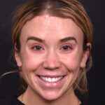 Atlanta chin implant best augmentation before after expert plastic surgery