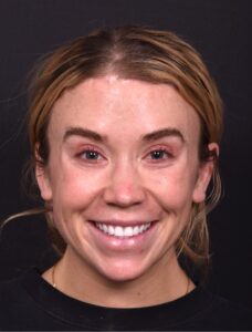 Atlanta chin implant best augmentation before after expert plastic surgery
