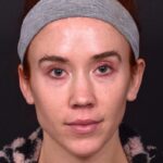 Atlanta chin implant best augmentation before after expert plastic surgery
