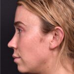 Atlanta chin implant best augmentation before after expert plastic surgery