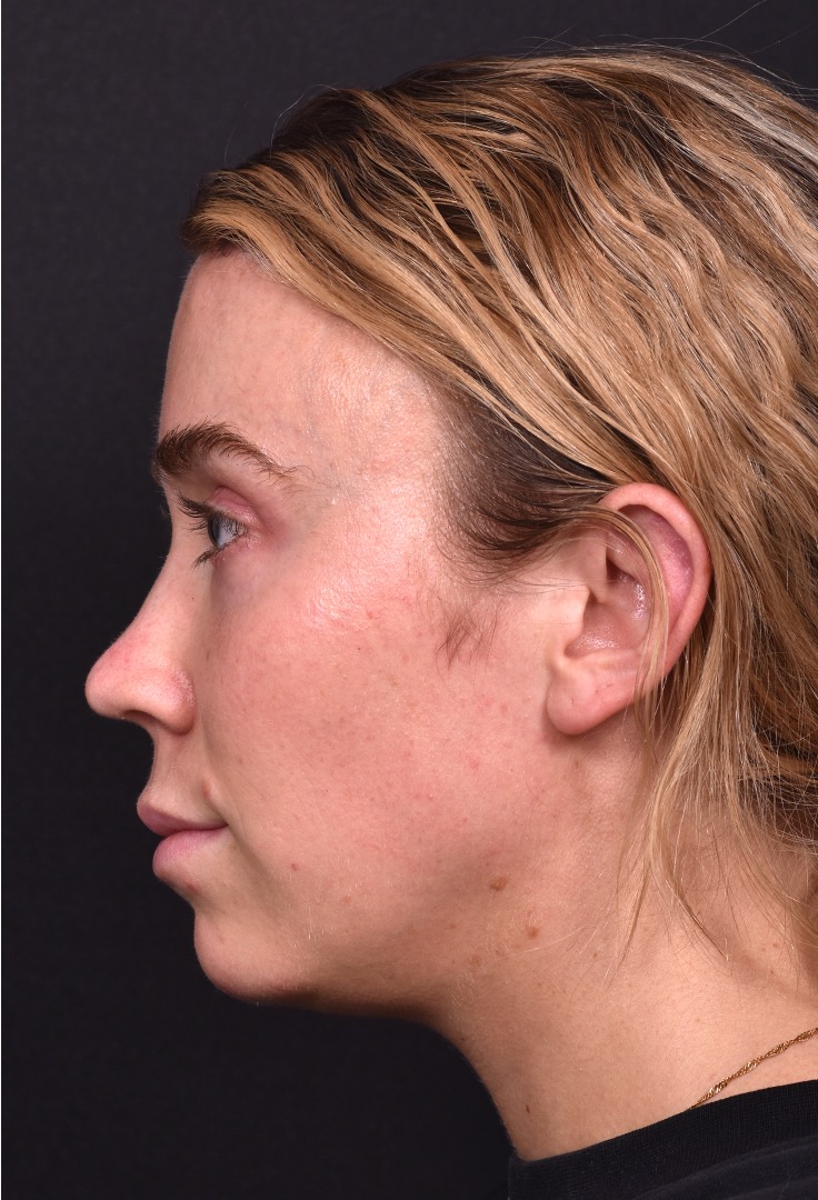 Atlanta chin implant best augmentation before after expert plastic surgery