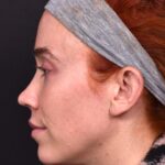 Atlanta chin implant best augmentation before after expert plastic surgery