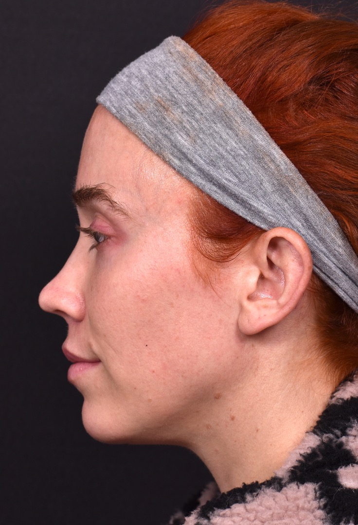 Atlanta chin implant best augmentation before after expert plastic surgery