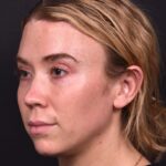 Atlanta chin implant best augmentation before after expert plastic surgery