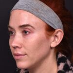 Atlanta chin implant best augmentation before after expert plastic surgery