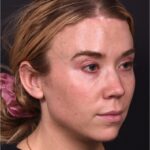 Atlanta chin implant best augmentation before after expert plastic surgery
